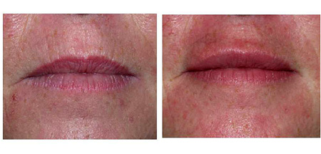 lip-rejuvenation-before-after.jpg