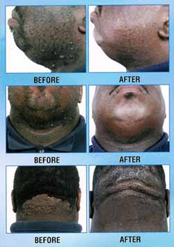 Ingrown Hairs NYC 212 644 9494 NYC Ingrown Hairs